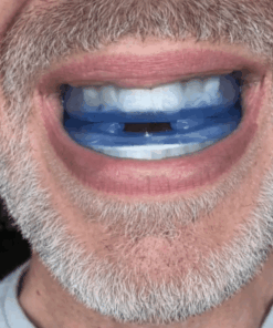 feliora mouthpiece 4 1.png